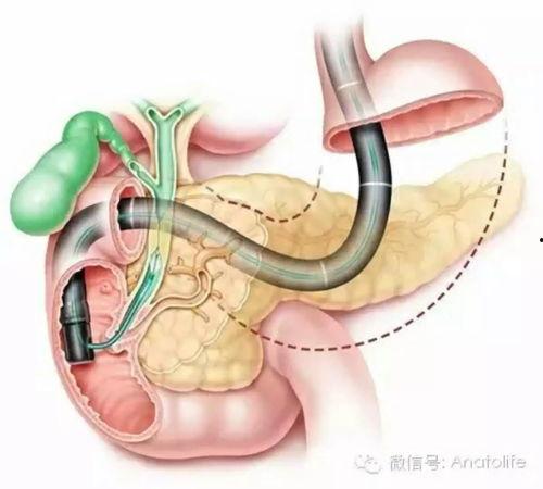 哪些明星网红切掉了胆囊,揭秘明星网红为何纷纷“割胆”