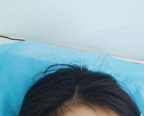 明星网红扎针灸疼痛大哭,疼痛瞬间成焦点